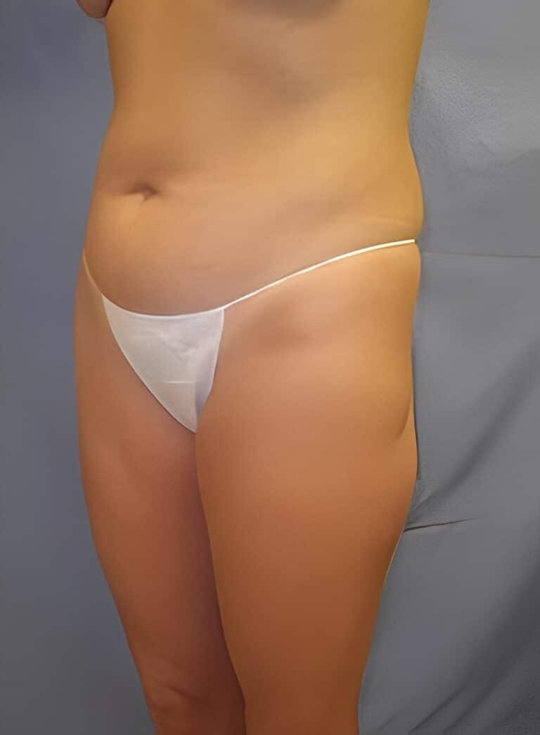 Before Image: Liposuction Back-Dr. Kenrick Spence - left-front-oblique