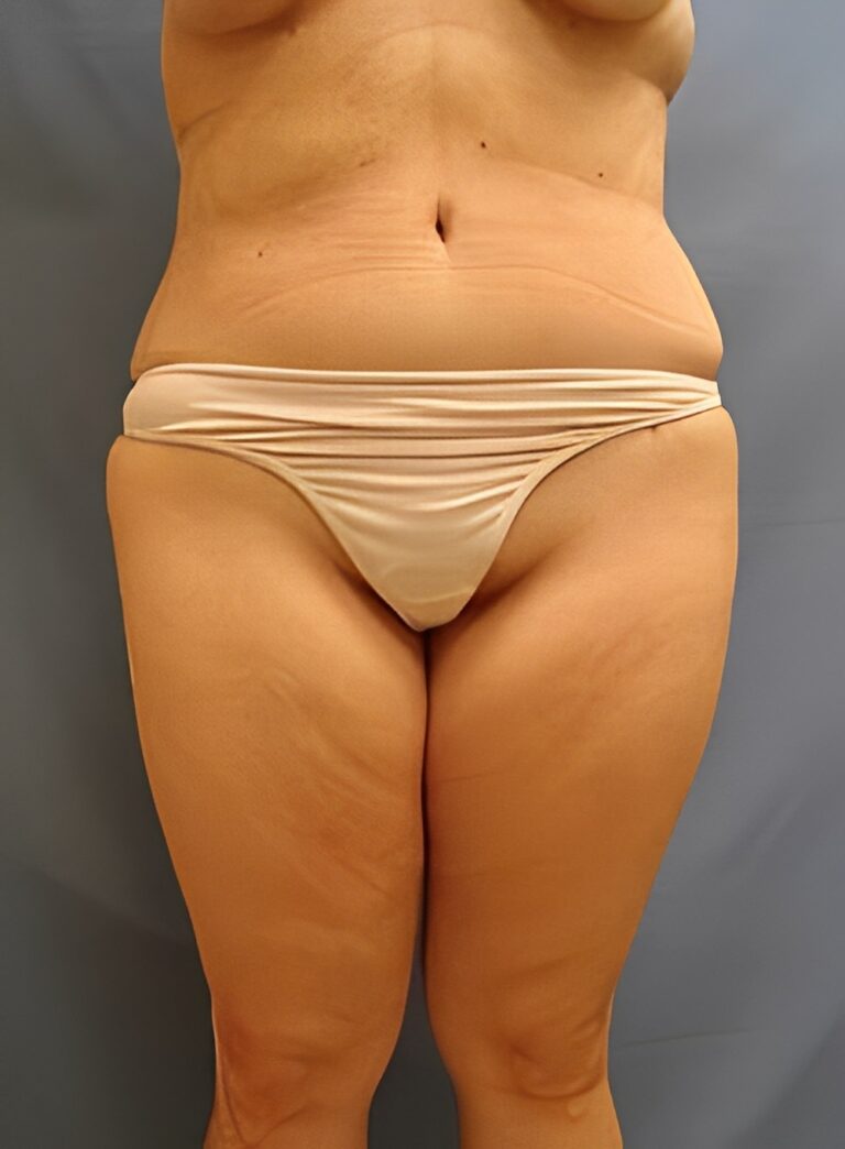 After Image: Liposuction Back-Dr. Kenrick Spence - front