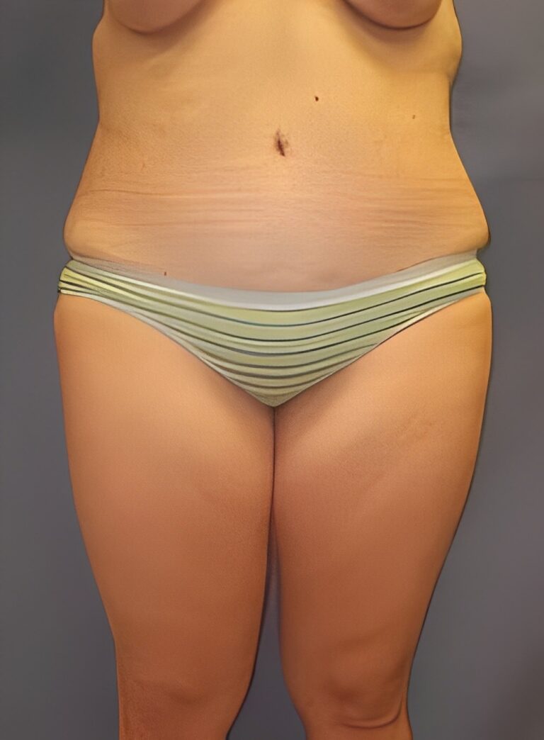 Before Image: Liposuction Back-Dr. Kenrick Spence - front