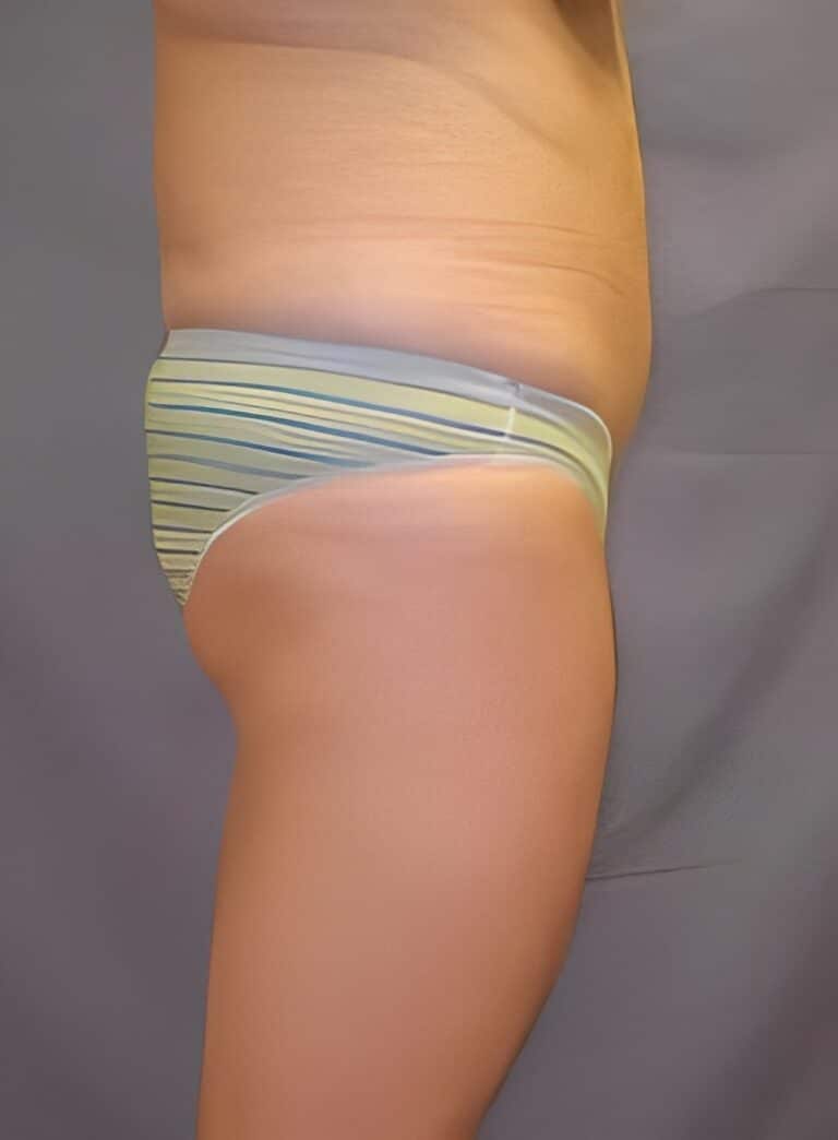 Before Image: Liposuction Back-Dr. Kenrick Spence - right-side