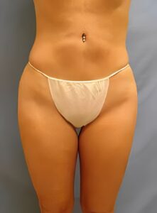 SculptEase™ Liposuction-Dr. Kenrick Spence