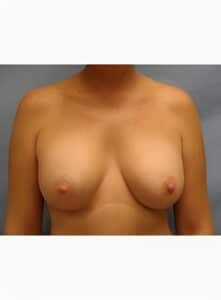 Breast Augmentation-Dr. Kenrick Spence