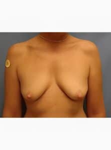 Breast Augmentation-Dr. Kenrick Spence