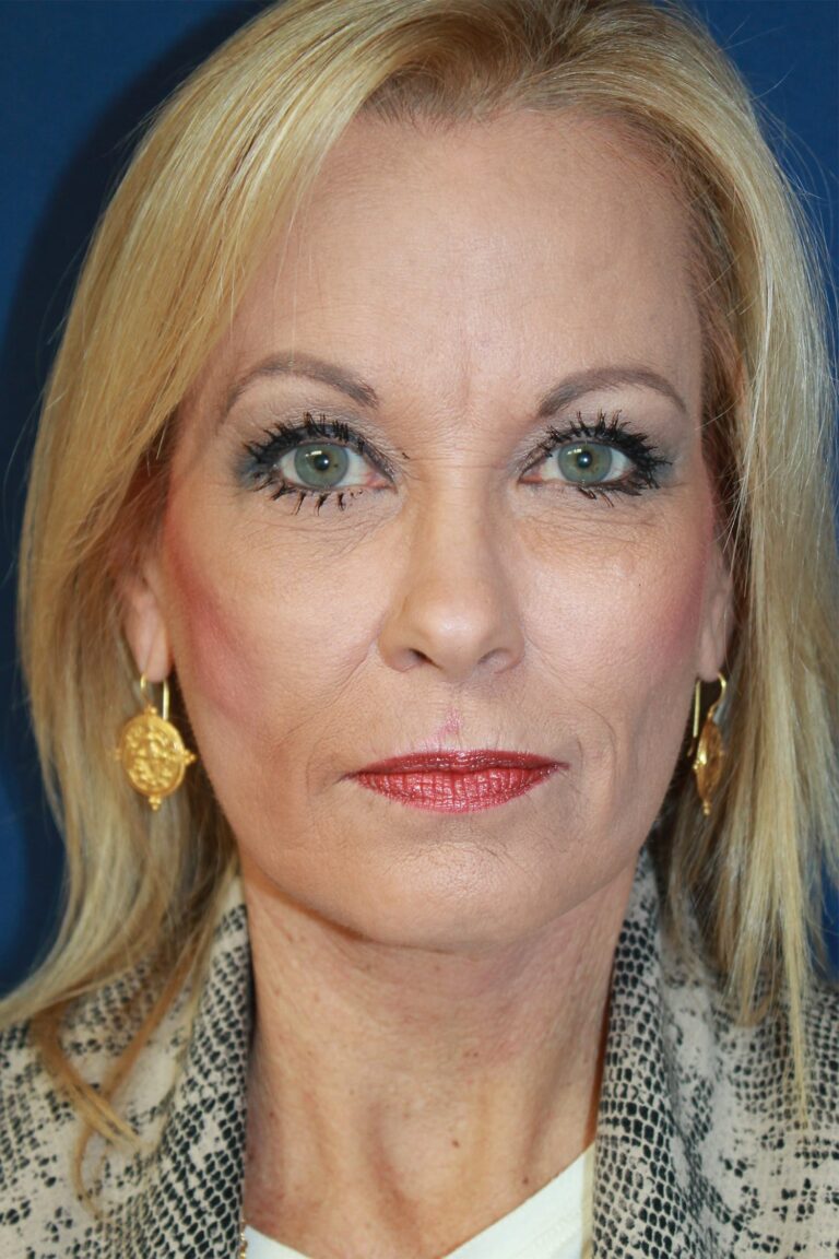 After Image: Facelift-Dr. Kenrick Spence - front