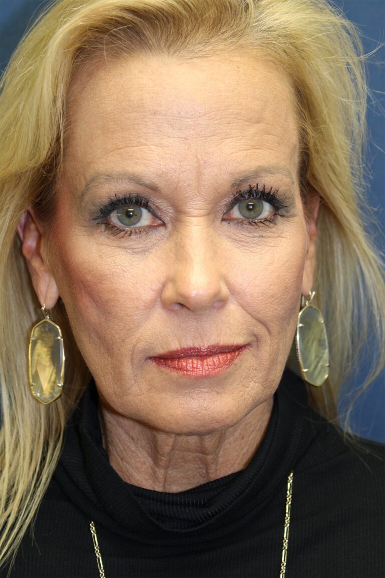 Before Image: Facelift-Dr. Kenrick Spence - front