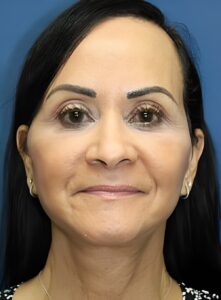 Facelift-Dr. Kenrick Spence