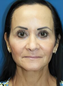 Facelift-Dr. Kenrick Spence