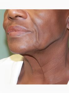 Neck Lift-Dr. Kenrick Spence