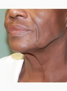 Estiramiento facial inferior-Dr. Kenrick Spence