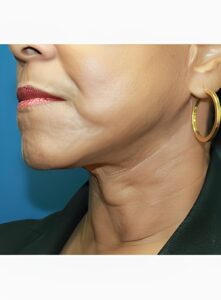 Lower Face lift-Dr. Kenrick Spence