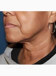 Lower Face lift-Dr. Kenrick Spence