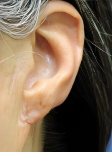 After Image: Keloid Removal-Dr. Kenrick Spence