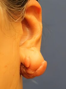 Before Image: Keloid Removal-Dr. Kenrick Spence