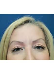 After Image: Botox-Dr. Kenrick Spence