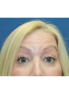 Before Image: Botox-Dr. Kenrick Spence