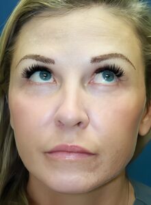 Botox-Dr. Kenrick Spence