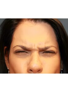 Before Image: Botox-Dr. Kenrick Spence