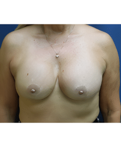 Breast Implant Revisions-Dr. Fernando Ovalle