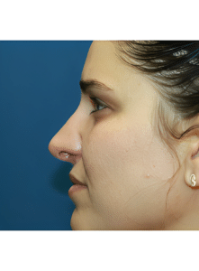 Nose Surgery-Dr. Kenrick Spence