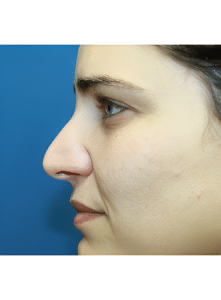 Nose Surgery-Dr. Kenrick Spence