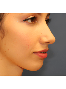 Nose Surgery-Dr. Kenrick Spence