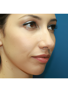 Nose Surgery-Dr. Kenrick Spence