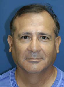 Nose Surgery-Dr. Kenrick Spence