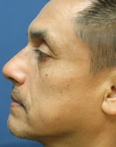 Nose Surgery-Dr. Kenrick Spence