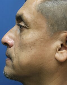 Nose Surgery-Dr. Kenrick Spence