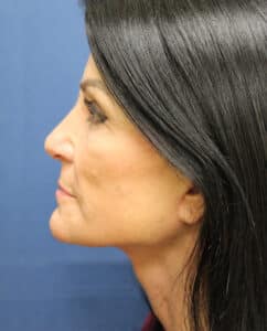 Lower Facelift – Dr. Kenrick Spence