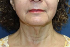 Necklift-Dr. Kenrick Spence