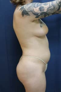 86445 Lipo 360 Before 1