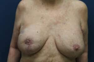 Revisiones de implantes mamarios-Dr. Fernando Ovalle
