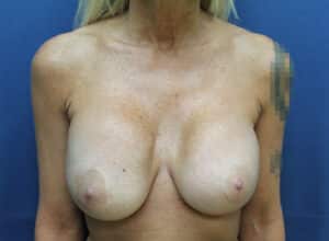 Bilateral Breast Implant Exchange – Kenrick Dr. Spence