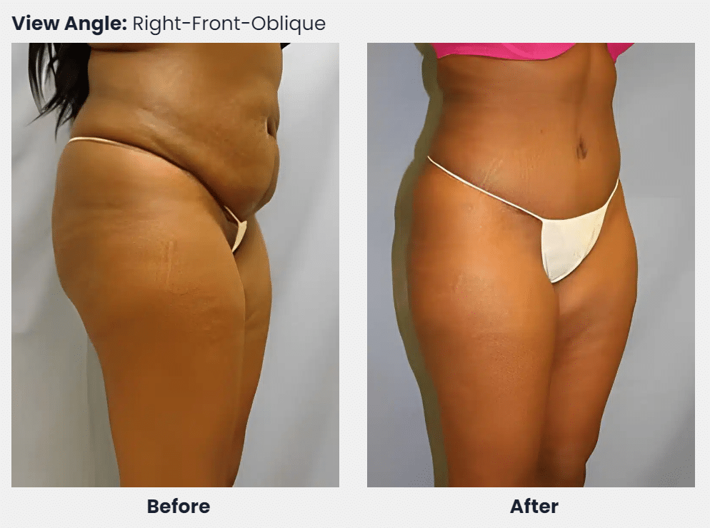 Tummy Tuck from Right Angle Before and After