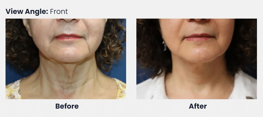 Neck Lift Before and After from Front View