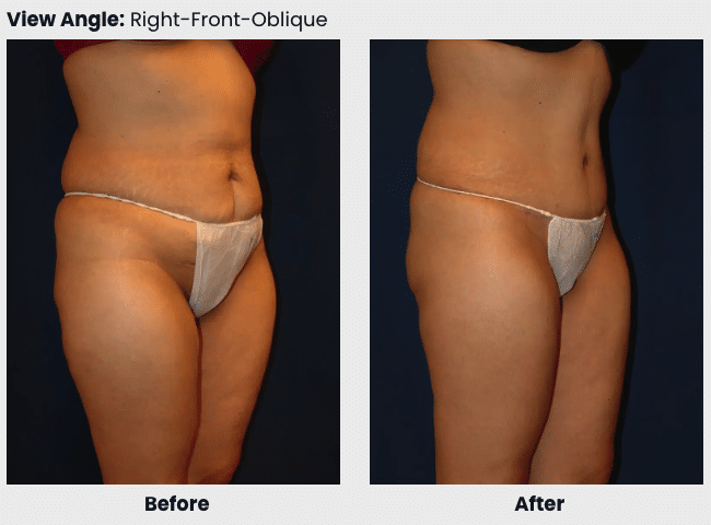 abdominoplasty before after 2