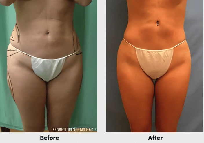 liposuction before after 1