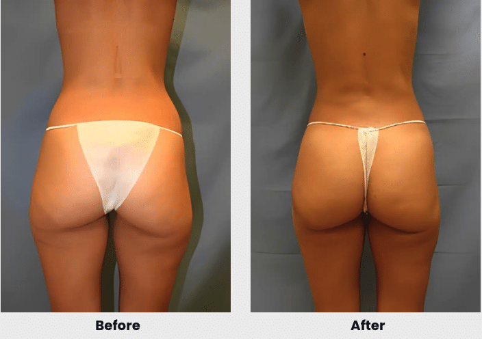 liposuction before after 2