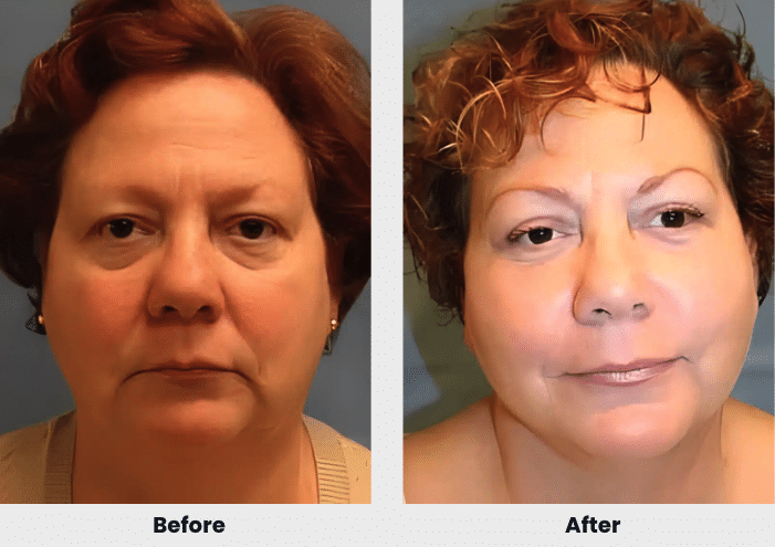 liposuction before after 3