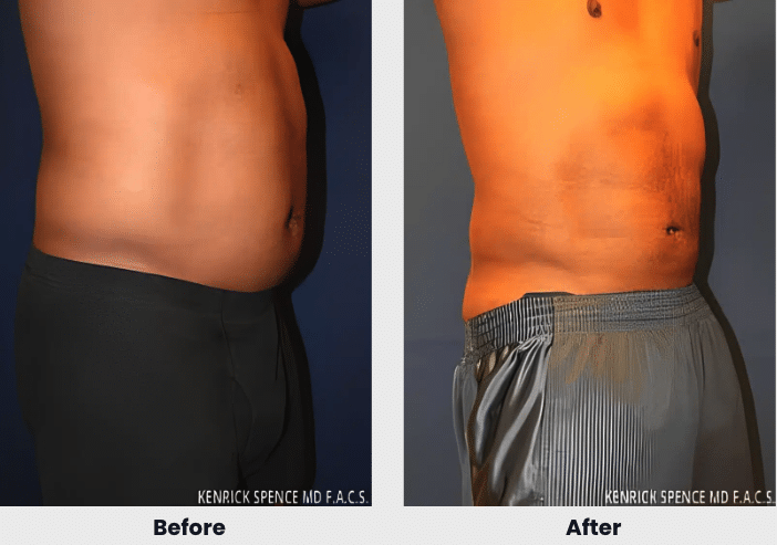 liposuction before after 4