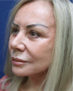 After Image: Brow Lift & Eyelid Surgery and Lower Facelift– Dr. Kenrick Spence