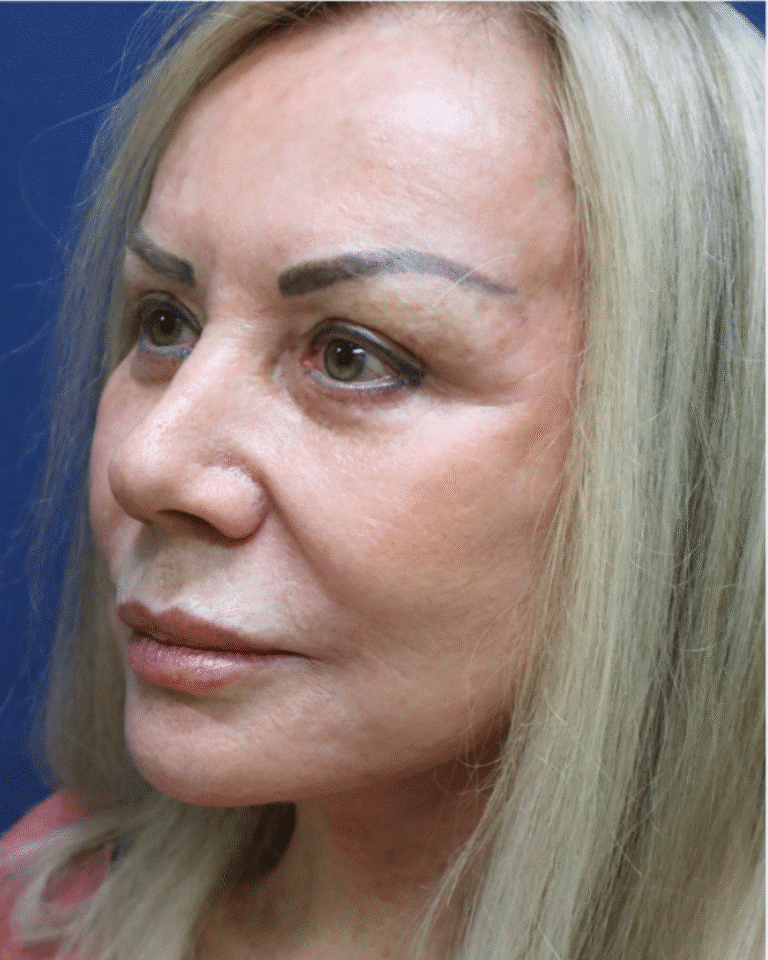 After Image: Brow Lift & Eyelid Surgery and Lower Facelift– Dr. Kenrick Spence - left-front-oblique