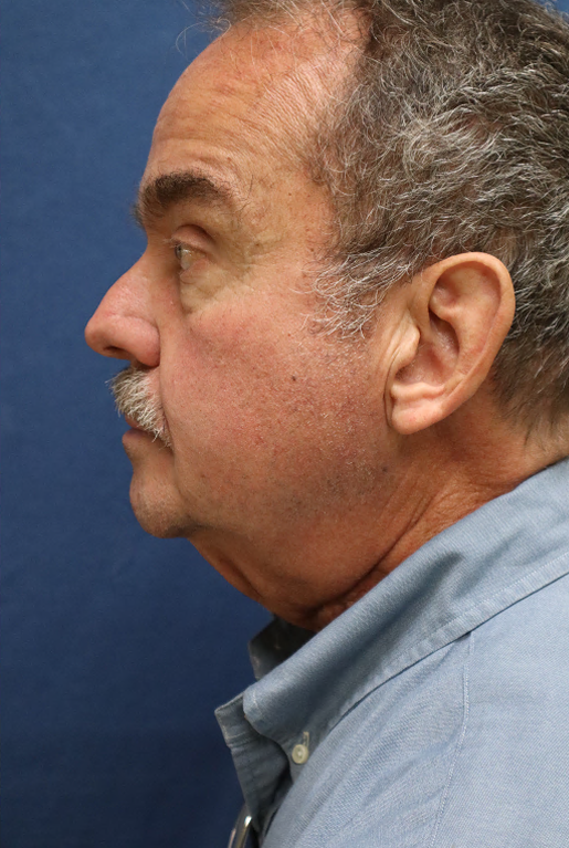 Before Image: Lower Facelift, Neck Lift, Brow Lift, Eyelid Surgery & Fat Grafting-Dr. Kenrick Spence - left-side