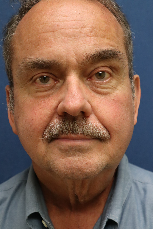 Before Image: Lower Facelift, Neck Lift, Brow Lift, Eyelid Surgery & Fat Grafting-Dr. Kenrick Spence - front