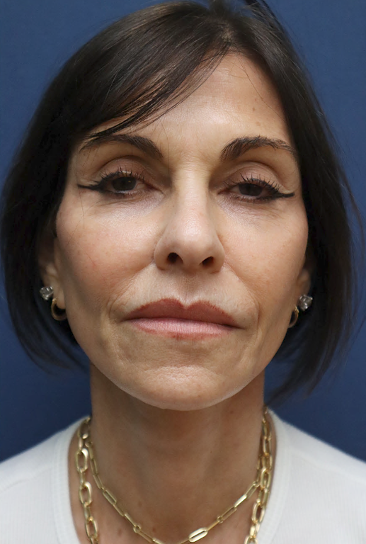 After Image: Brow Lift, Facelift, Fat Grafting and Lip Lift-Dr. Kenrick Spence - front