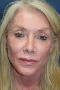 After Image: Neck Lift, Facelift, Brow Lift, Fat Grafting, and Microneedling-Dr. Kenrick Spence