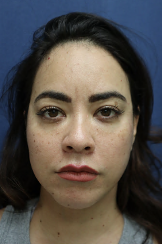 After Image: Facelift, Neck Lift, Neck Liposuction, and Lip Lift-Dr. Kenrick Spence - front