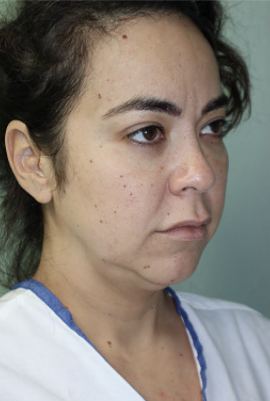 Before Image: Facelift, Neck Lift, Neck Liposuction, and Lip Lift-Dr. Kenrick Spence - right-front-oblique