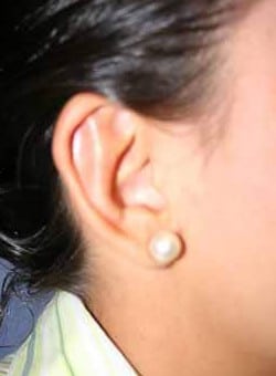 Ear Surgery-Dr. Kenrick Spence